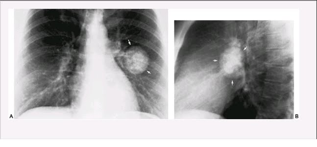 tuberculoma光