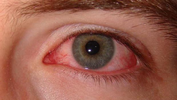 viral conjunctivitis symptoms and treatment