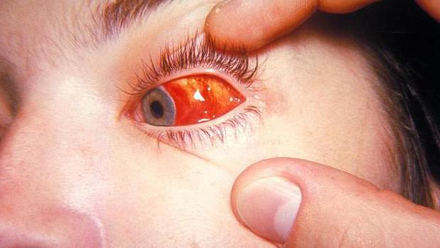 ウイルスの眼球結膜炎
