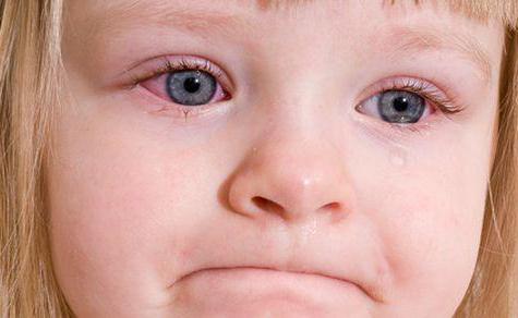 virale Konjunktivitis bei Kindern Symptome