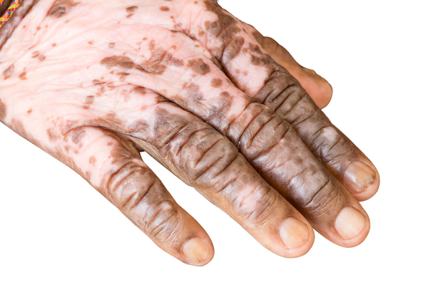 Vitiligo-Ursache