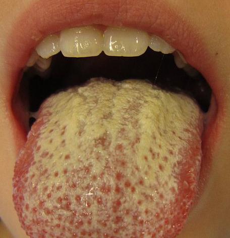 the child candidiasis