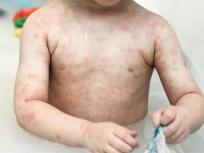 candidiasis of the skin of children