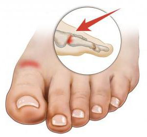 what to do if swollen toe