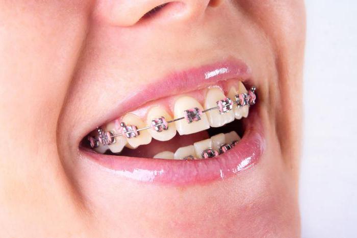 separação dos dentes consequências
