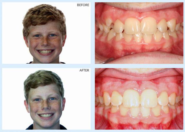 分离的牙齿之前和之后的照片