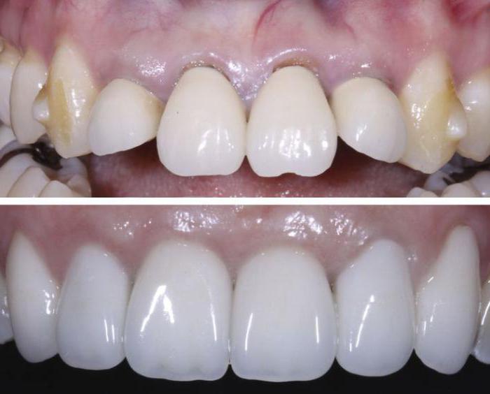 separacja zębów przed i po