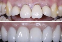 Separação dos dentes: antes e depois