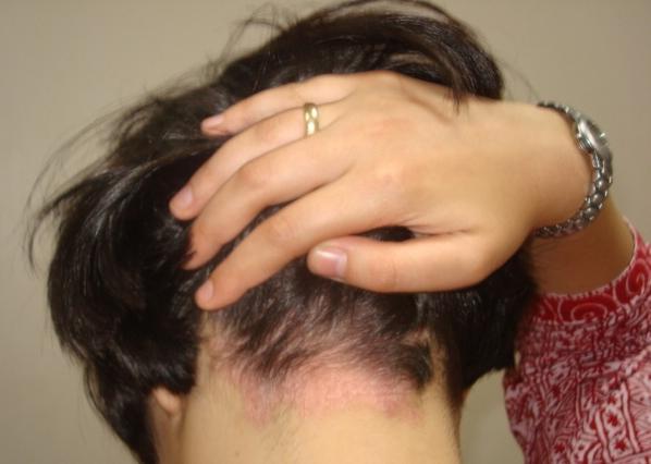 Psoriasis der Kopfhaut Symptome