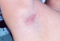 Why a sore armpit?