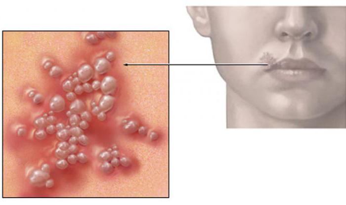 疱疹的上嘴唇的原因