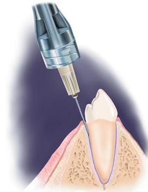 Ultrakain en odontología