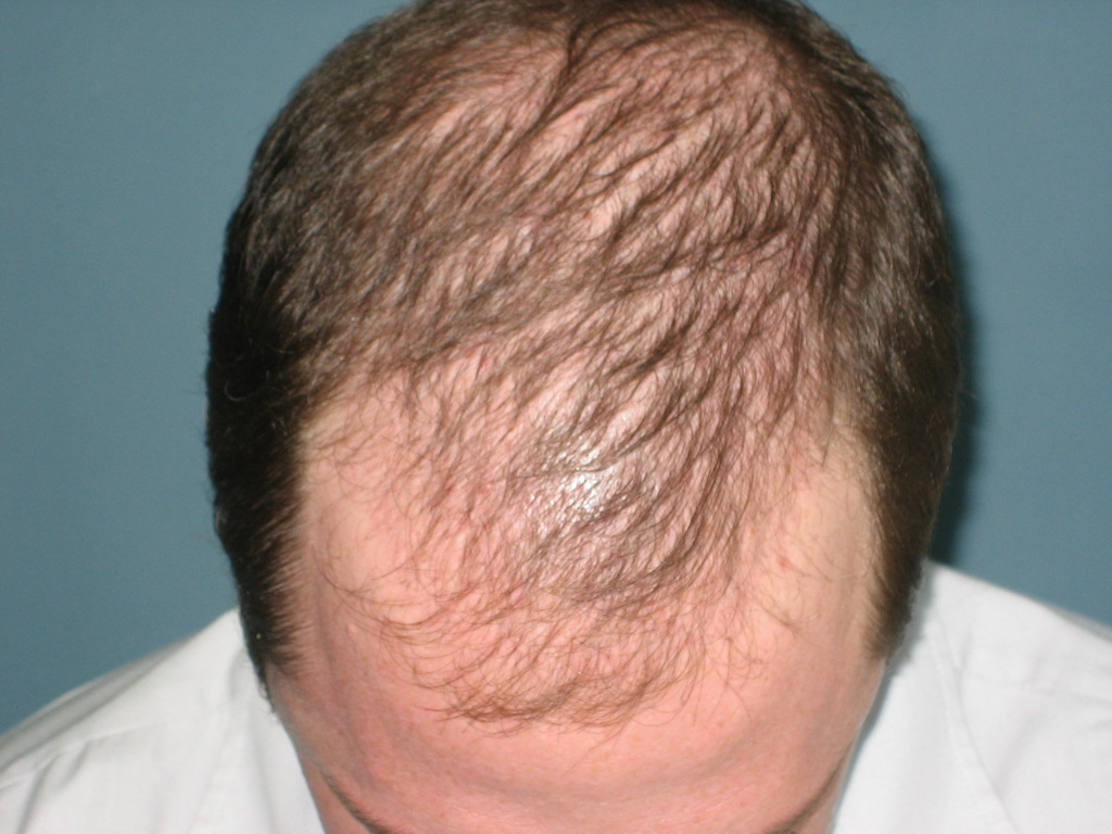 Androgenetische Alopezie