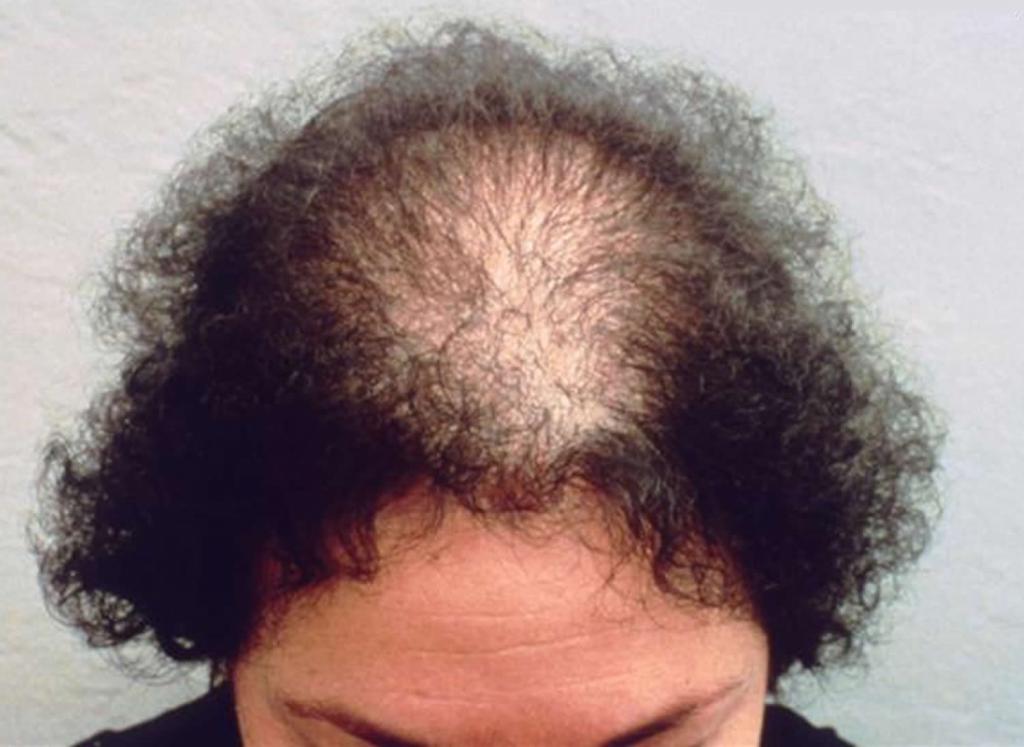 alopecia androgenética em mulheres
