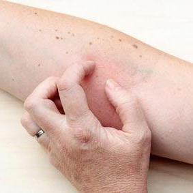 how to treat pityriasis rosea in humans ointment