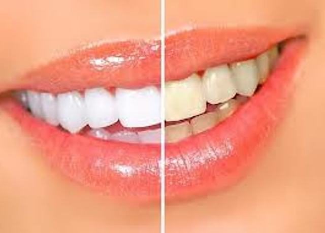 दांत Whitening हाइड्रोजन पेरोक्साइड