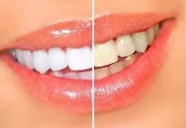 独立的牙齿漂白过氧化氢。