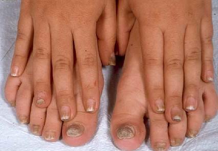 las Herramientas de hongos en las uñas de los pies