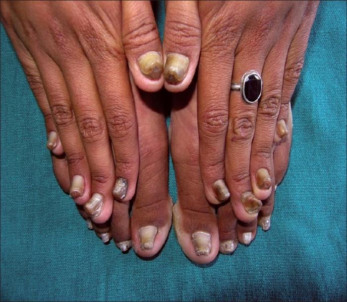 nail Polish from nail fungus on feet