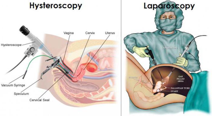 laparoscopy and hysteroscopy