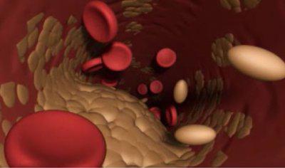 Produkte erhöhen das Cholesterin im Blut