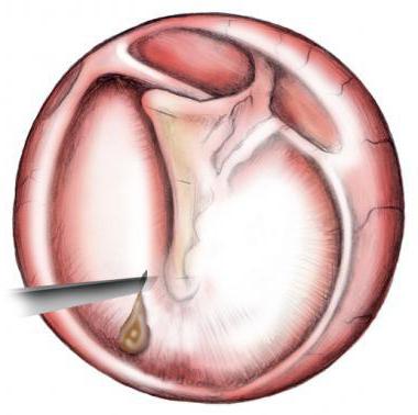 के बाद एक paracentesis के कान की झिल्ली