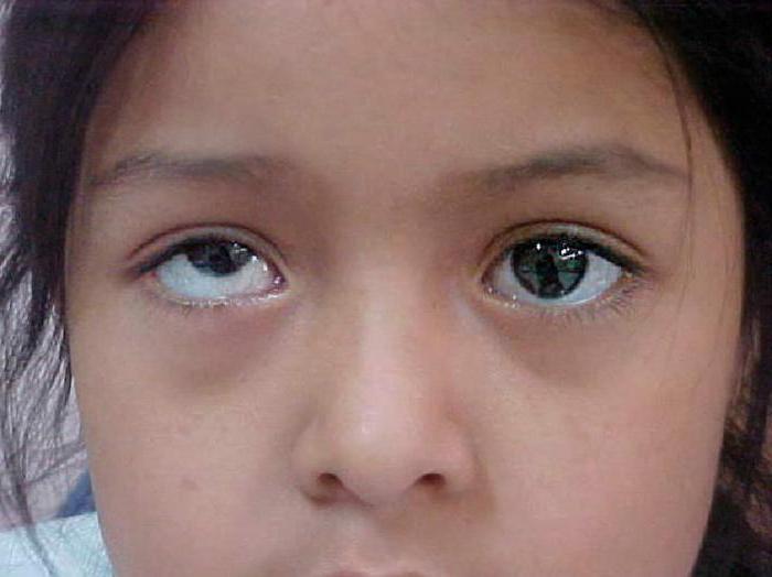 los ojos en diferentes direcciones