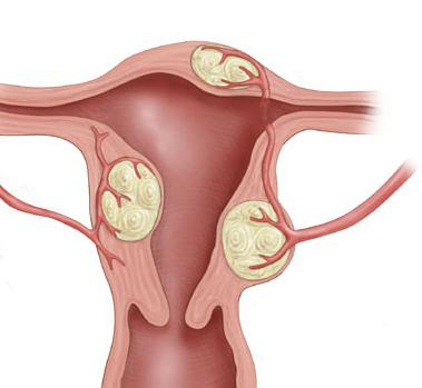 signos de los miomas uterinos cómo reconocer