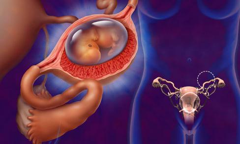 signos de los fibromas uterinos de los pequeños