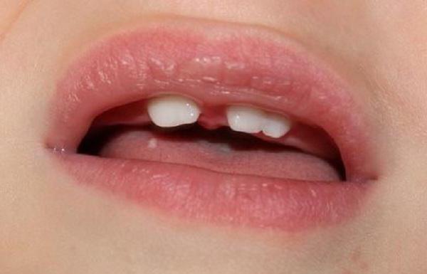 如何区分一个牙齿有根的宝贝？