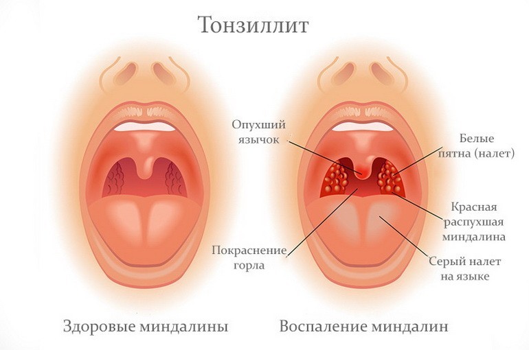 慢性扁桃腺