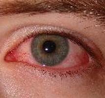 Entzündung der Regenbogenhaut des Auges