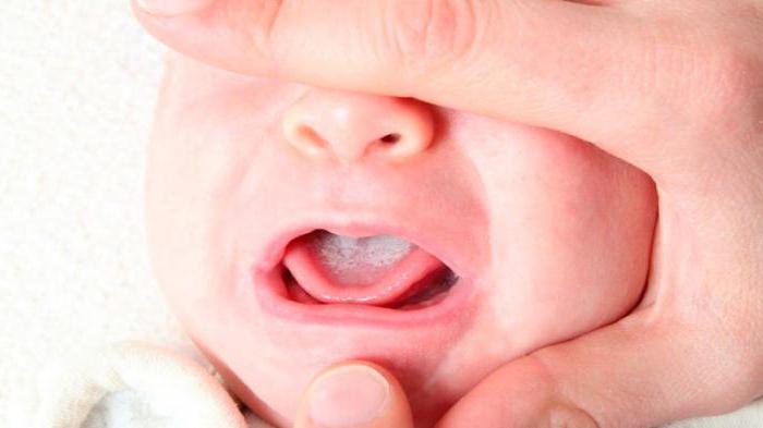 stomatitis in infants
