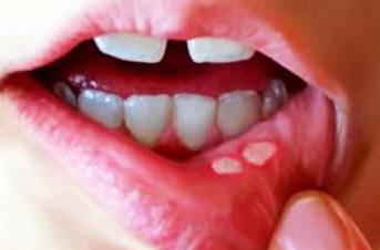 viralen Entzündung der Mundschleimhaut bei Kindern wie lange dauert