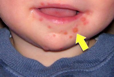  Stomatitis bei Kindern komarovskij