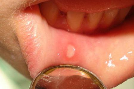 zapalenie jamy ustnej u dzieci ile dni trzyma