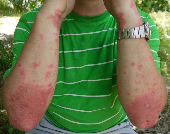 алергія на солярій симптоми