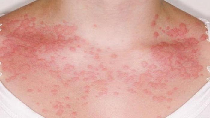 allergisch auf die süßen Symptome bei Erwachsenen