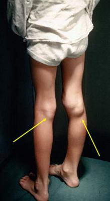 嚢胞ベッカー膝関節写真