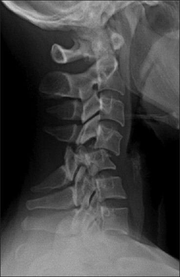 kırık 6 servikal vertebra