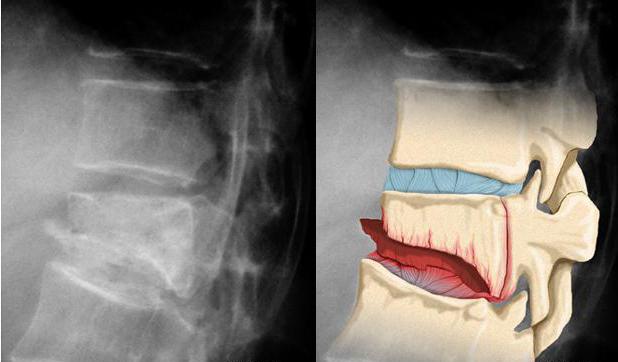 fracture of the 7th cervical vertebra