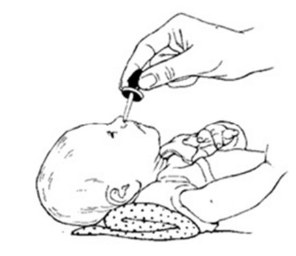 how to suck the snot from a baby's aspirator