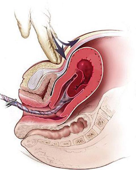 métodos de separação manual da placenta