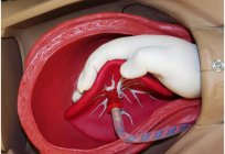 A separação manual da placenta: métodos e técnica de execução