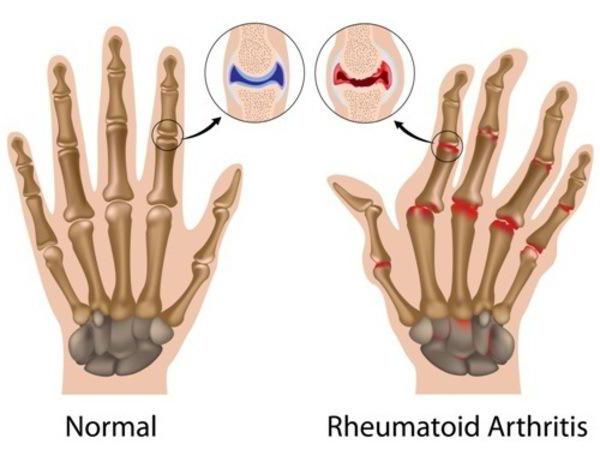 juvenil romatoid artrit