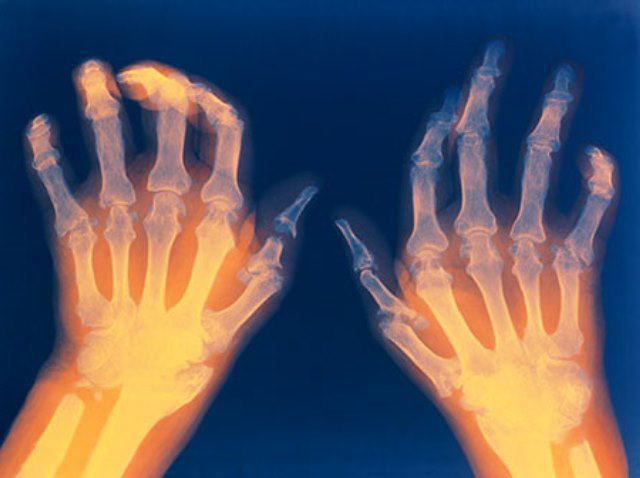 ювенильный artrite reumatóide cid 10