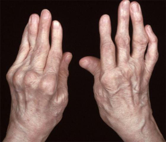 la artritis reumatoide juvenil, el código de la cie-10