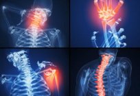 ICD 10. Romatoid artrit: belirtileri ve tedavisi