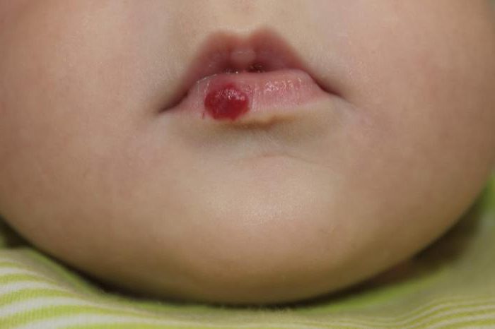 hemangioma en los labios