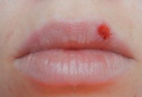 Точки на губах червоні: причини появи й способи лікування